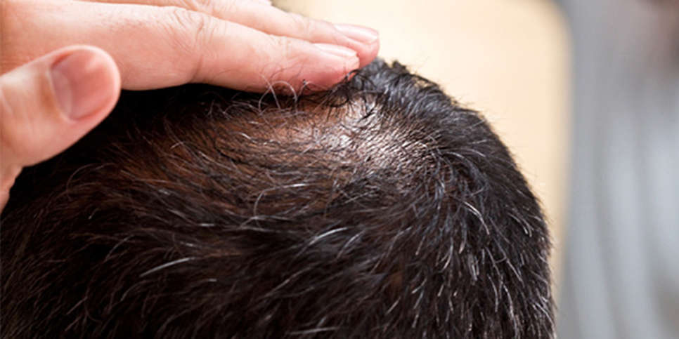 Cuáles son las causas de la caída de pelo